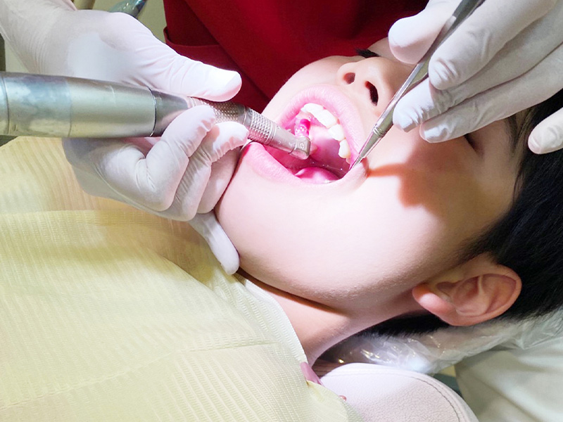 虫歯の治療・予防